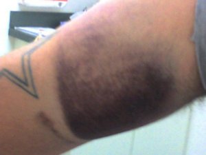 bruise.jpg